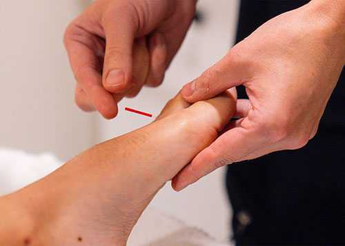 Acupuncture
